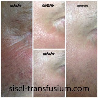 Before and After Anti Aging Cream - Transfusium - Sisel International