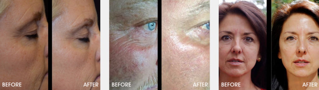 Before and After using Sisel's Transfusium - Anti Aging Skin Care