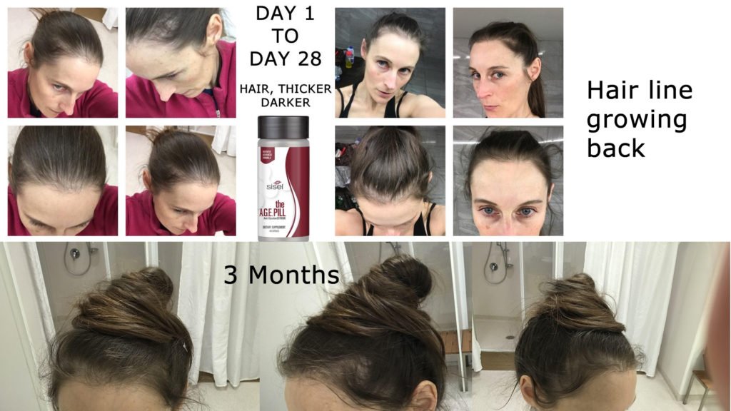 Age Pill Results hair regrowth 3 months