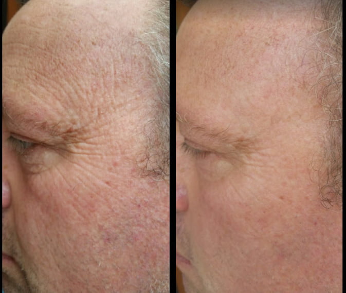 Before and After Sisel's Timeless Renewal Skin Care System