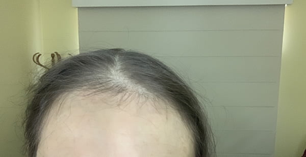 Growing Hair back - Could this be life extension?
