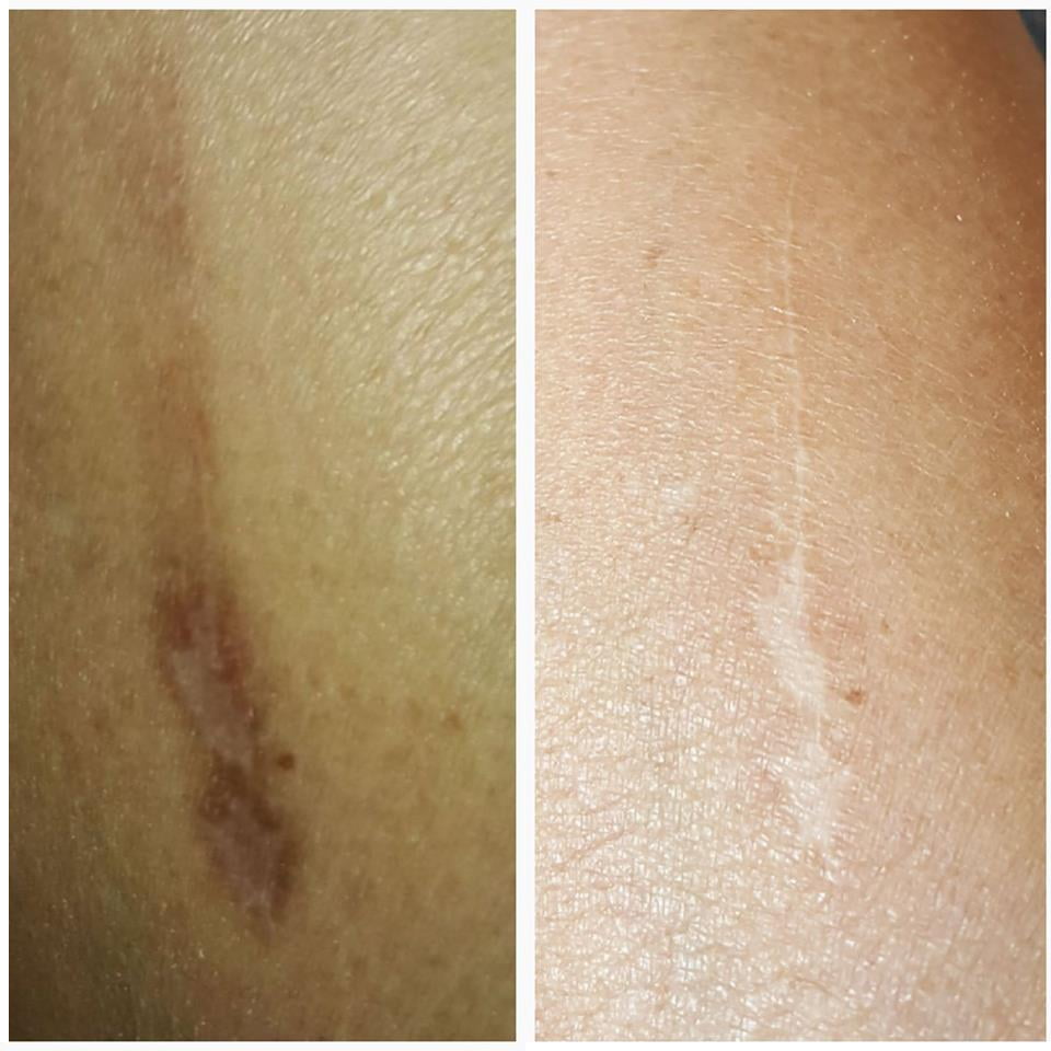 scar testimonial Sisel Age Pill and Triangle of Life