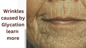 Wrinkles caused by glycation